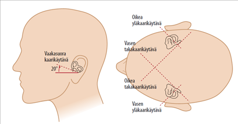 Nystagmus nystagmus