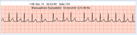 Raskaudenaikainen Supraventrikulaarinen Takykardia Raskaudenaikainen Supraventrikulaarinen Takykardia