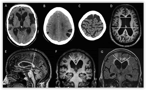 normaalipaineisen-hydrokefaluksen-kliininen-kuva-diagnostiset