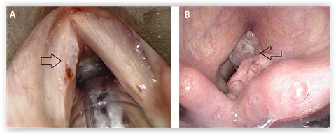 papillomavirus oireet)