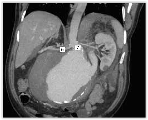 vatsa-aortan-j-ttianeurysma