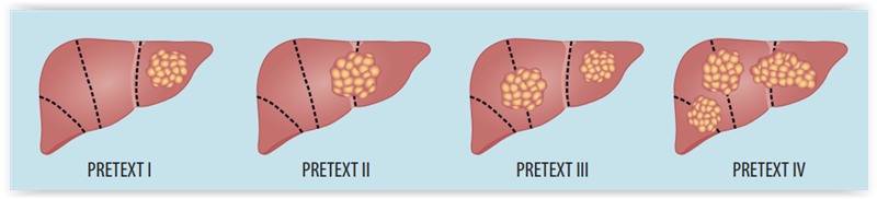 Hepatoblastooma: kohti entistä parempaa ennustetta