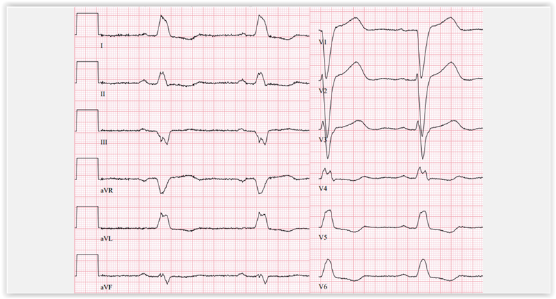 haarakatkos-ekg-ss-milloin-konsultoin-erikoissairaanhoitoa