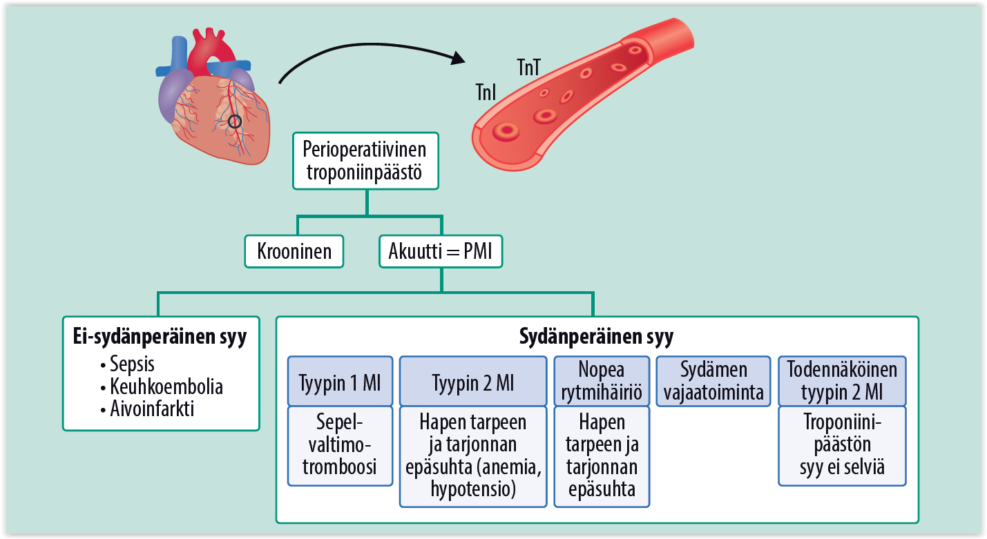 perioperatiivinen-syd-nlihasiskemia-edelleen-alidiagnosoitu-ongelma