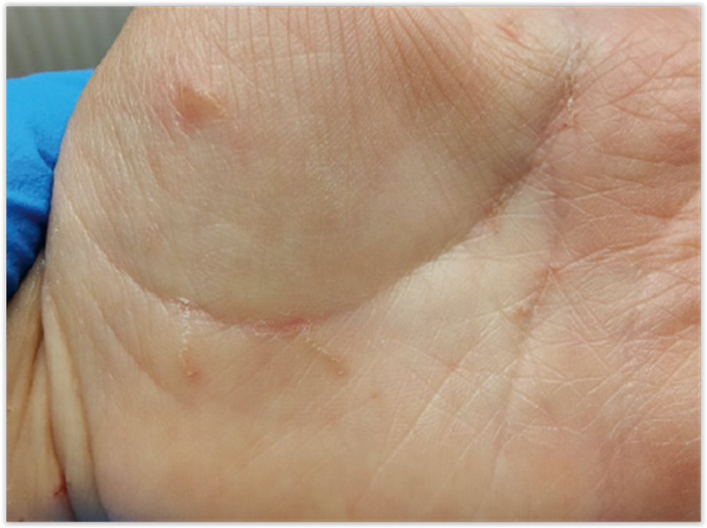 Syyhy scabies 