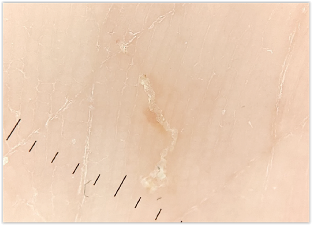 Syyhy scabies 