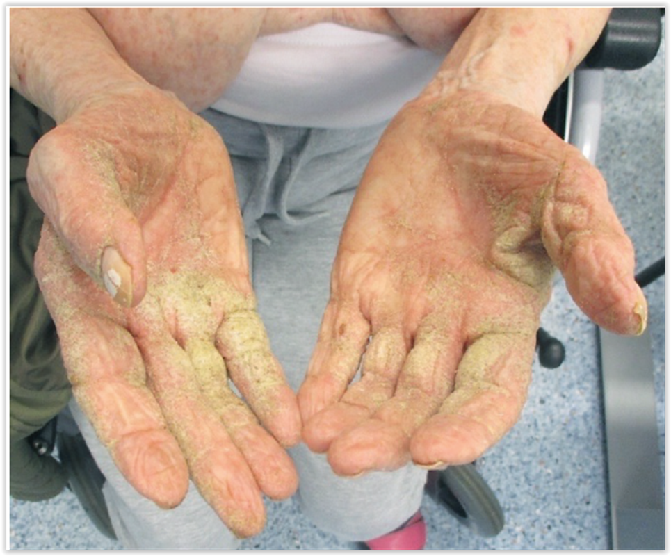 Syyhy scabies 
