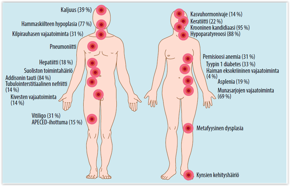 APECED-tauti - suomalaisen tautiperinnön harvinainen ...