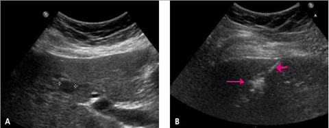 Maksan Ja Sappiteiden Toimenpideradiologia Maksan Ja Sappiteiden Toimenpideradiologia